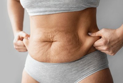 Sagging Skin After Gastric Sleeve
