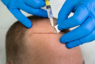 Haartransplantatie in Istanbul