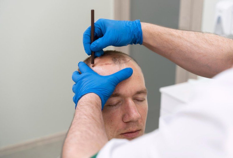 Beste haartransplantatie in Istanbul, topdoktoren, beoordelingen, prijzen