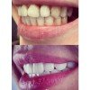 Dt. Suzan Yavaşca Dentalfurnier 7
