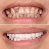 Uzmanlar Dental Clinic Dentalfurnier 2
