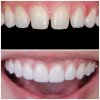 Uzmanlar Dental Clinic Dentalfurnier 3