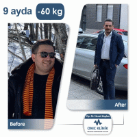 Dr.Necat Kaplan Gastric Sleeve Surgery in Turkey - Price/Cost & Reviews 7