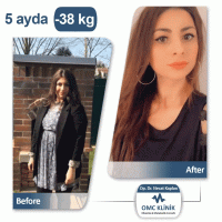Dr.Necat Kaplan Gastric Sleeve Surgery in Turkey - Price/Cost & Reviews 8