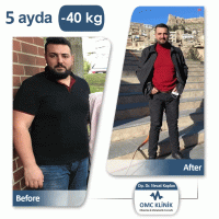 Dr.Necat Kaplan Gastric Sleeve Surgery in Turkey - Price/Cost & Reviews 9